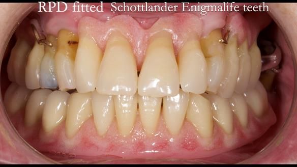 Finlay's Newsletter 59 Ultra hard partial dentures made for Gill