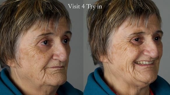 Newsletter 83: Sheila’s Complete Denture Success