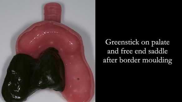 Finlay's Newsletter 60 Sylvia's upper Kennedy Class 2 Mod 1 metal based upper RPD