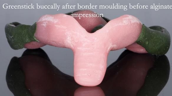 Newsletter 54 case presentation upper complete denture and lower Scandinavian designed hygienic partial denture for David