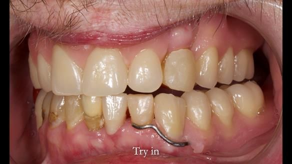 Newsletter 55 Provision of metal based partial dentures for Zephyrine with a repaired cleft lip and palate