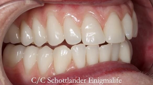 Replacing Madeline’s Complete denture FULL PROTOCOL