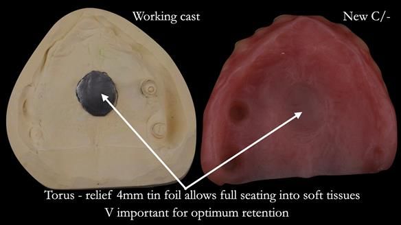 Solving Linda’s Failed “All on 4” implant bridges - full protocol Newsletter 42