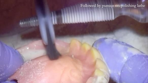 Finlay's Newsletter 62 provision of extractions and metal based complete dentures for Rafique