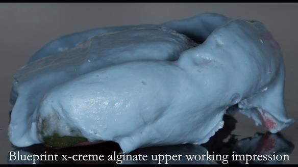 Newsletter 75: Marion’s case - Step-by-step complete denture workflow