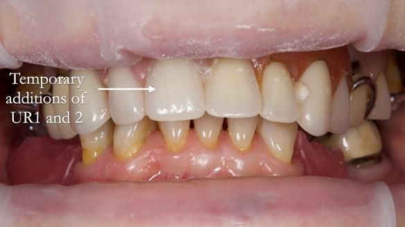 Eileen's transformation with upper and lower RPDs of Scandinavian hygienic design FULL PROTOCOL