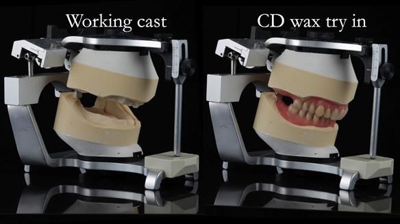 Finlay's Newsletter 62 provision of extractions and metal based complete dentures for Rafique
