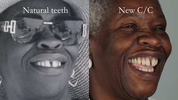 Newsletter 53 showing the making and fitting of ultra life-like dentures for Valena