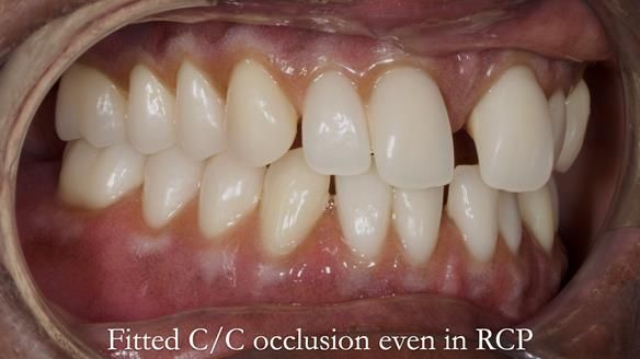 Newsletter 53 showing the making and fitting of ultra life-like dentures for Valena
