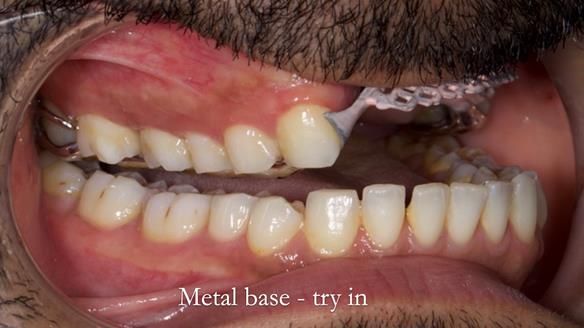 Upper metal base partial denture/occlusal stabilisation splint/obturator - full protocol