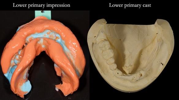 Newsletter 82 Mary - A complete upper and a one-tooth gasket denture