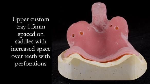 Finlay's Newsletter 59 Ultra hard partial dentures made for Gill