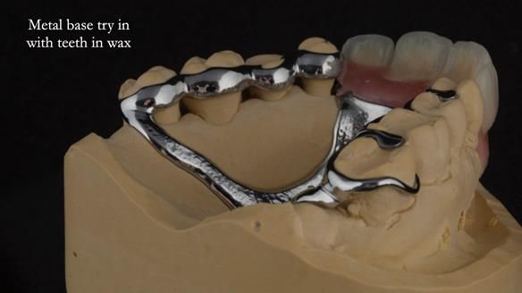 Finlay's Newsletter 63 Case study provision of metal based Scandinavian RPD - functional 10 years on