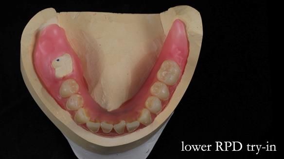 Newsletter 82 Mary - A complete upper and a one-tooth gasket denture