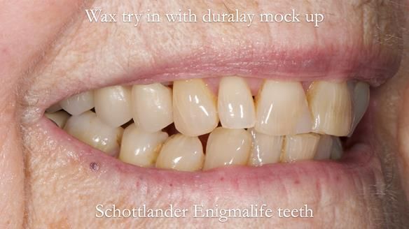 Finlay's Newsletter 60 Sylvia's upper Kennedy Class 2 Mod 1 metal based upper RPD