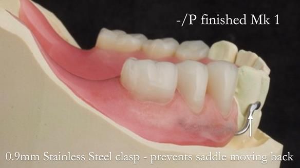 Newsletter 52 Managing Jo’s failing dentition with extractions and Mk 1/Mk 2 complete upper dentures and lower partial dentures FULL PROTOCOL