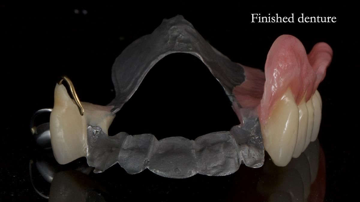 Newsletter 89 – Simon: A Challenging Kennedy Class II Division 1 Upper CoCr Partial Denture with a High Smile Line