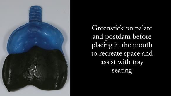 Newsletter 56 showing the making and fitting of a bilateral free end saddle upper removable partial denture (RPD) for patient with pemphigus