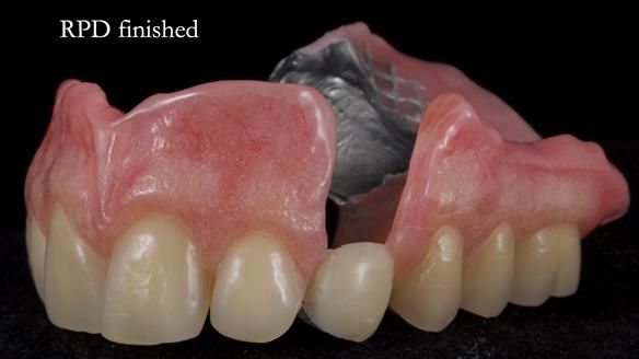 Newsletter 55 Provision of metal based partial dentures for Zephyrine with a repaired cleft lip and palate