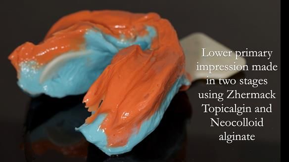 Managing poor implant positioning with complete dentures and Locator attachments - full protocol Newsletter 41