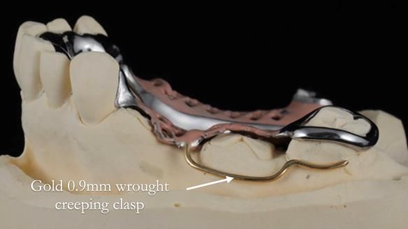 Finlay's Newsletter 60 Sylvia's upper Kennedy Class 2 Mod 1 metal based upper RPD