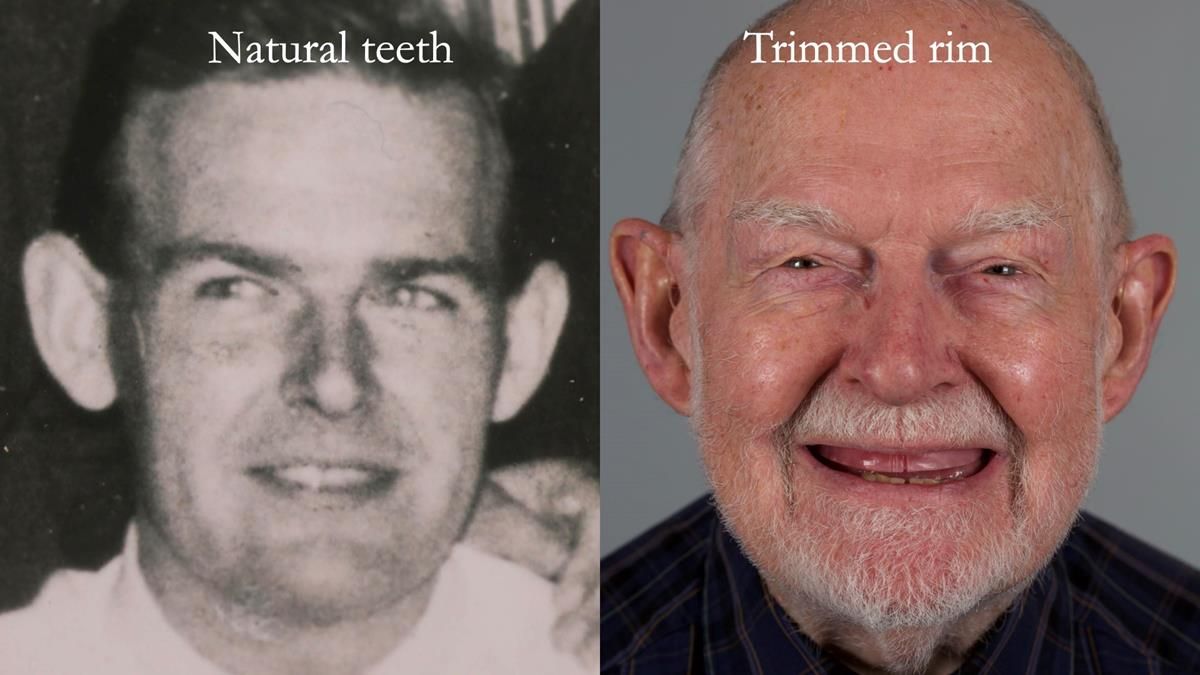 Newsletter 87 – Father Peter: A Partial Denture that needed Minor Miracle