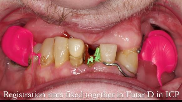 Newsletter 55 Provision of metal based partial dentures for Zephyrine with a repaired cleft lip and palate