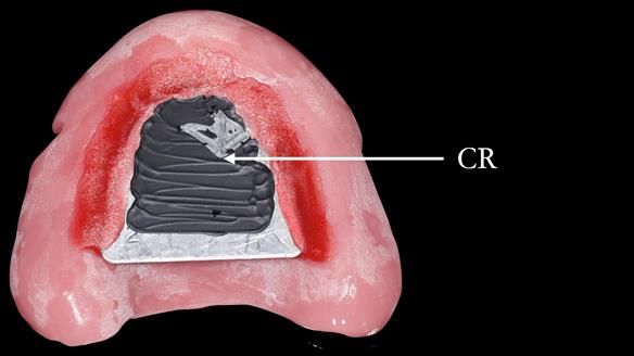 Complete denture Class II div 2 deep overbite Newsletter 39