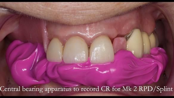 Newsletter 51 Managing Anne’s failing dentition with distal extension base RPD/Splint FULL PROTOCOL