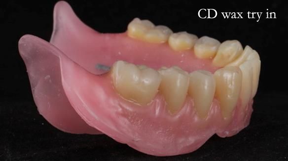 Finlay's Newsletter 62 provision of extractions and metal based complete dentures for Rafique