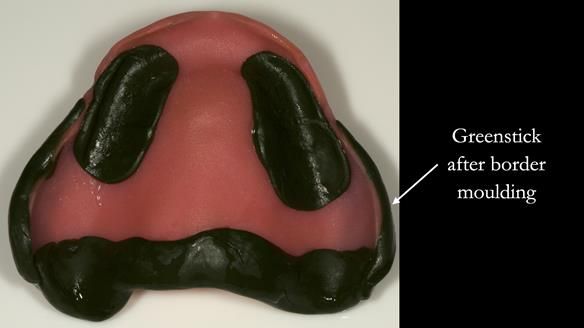 Greenstick - thinned after border moulding to functional width of the sulcus