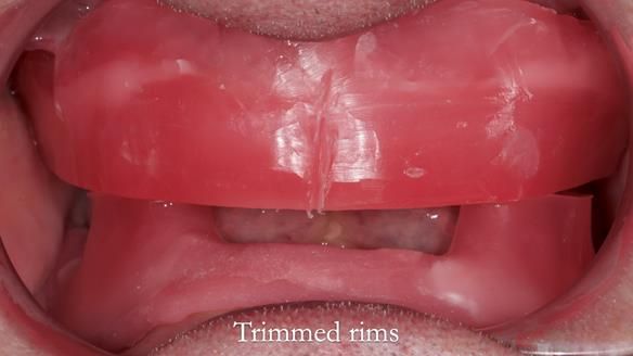 Complete denture Class II div 2 deep overbite Newsletter 39