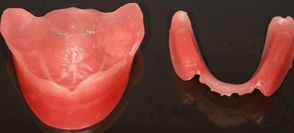 Figure 79 Primary registration rims used to record the APPROXIMATE centric relation (CR) and occlusal vertical dimension (OVD) to enable mounting of the definitive casts to fabricate the central bearing apparatus plates parallel to each other. Important s