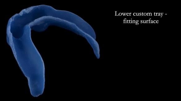 Newsletter 57 showcases the making and fitting process of implant-supported complete dentures for Alisdair