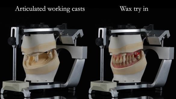 Finlay's Newsletter 59 Ultra hard partial dentures made for Gill