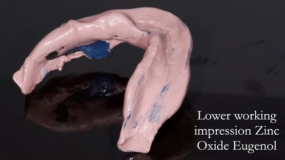 Newsletter 80 - Gordon’s dentures: the one case in 1,000 where my technique failed