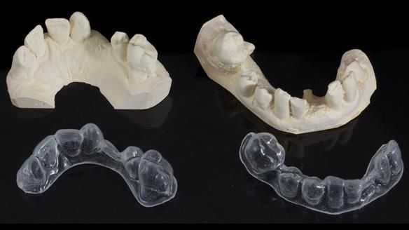 Newsletter 86 Peter the Architect — precision removable partial dentures case study