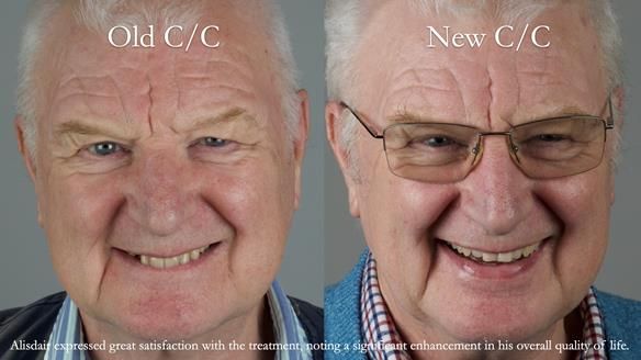 Newsletter 57 showcases the making and fitting process of implant-supported complete dentures for Alisdair