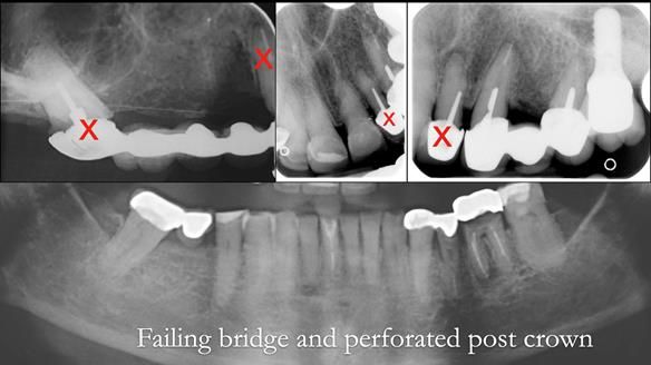 Newsletter 51 Managing Anne’s failing dentition with distal extension base RPD/Splint FULL PROTOCOL