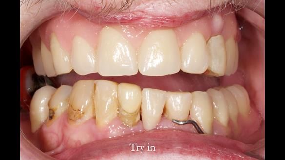 Newsletter 55 Provision of metal based partial dentures for Zephyrine with a repaired cleft lip and palate