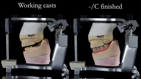 Newsletter 44 - extreme removable prosthodontics – engineering a super-strong and ultra-thin over denture