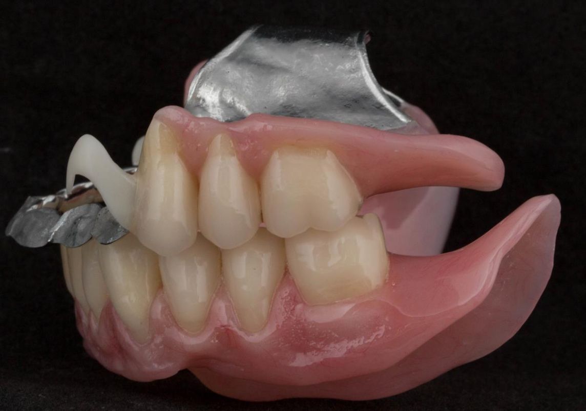 Upper free end saddle partial denture with high smile line and lower implant supported complete denture with suboptimal positioned dental implants - full protocol