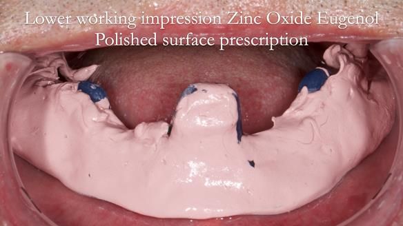 Newsletter 80 - Gordon’s dentures: the one case in 1,000 where my technique failed