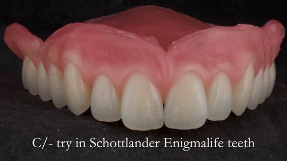 Managing poor implant positioning with complete dentures and Locator attachments - full protocol Newsletter 41