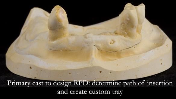 Finlay's Newsletter 59 Ultra hard partial dentures made for Gill