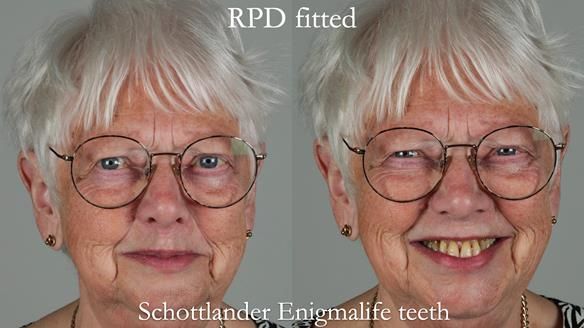 Finlay's Newsletter 59 Ultra hard partial dentures made for Gill