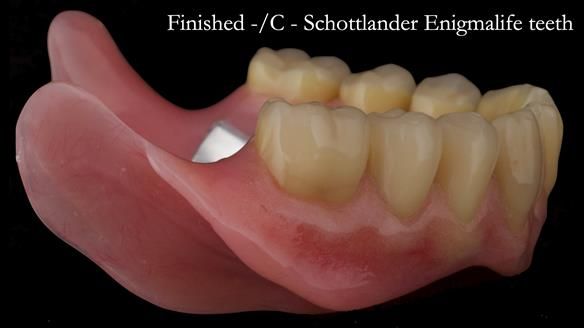Complete denture Class II div 2 deep overbite Newsletter 39