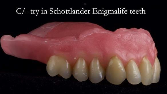 Newsletter 54 case presentation upper complete denture and lower Scandinavian designed hygienic partial denture for David