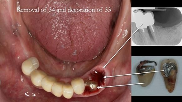 Ken – going downhill, first class