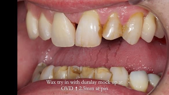Read Newsletter 67 - Brian's COMBAT DENTURE Case Study